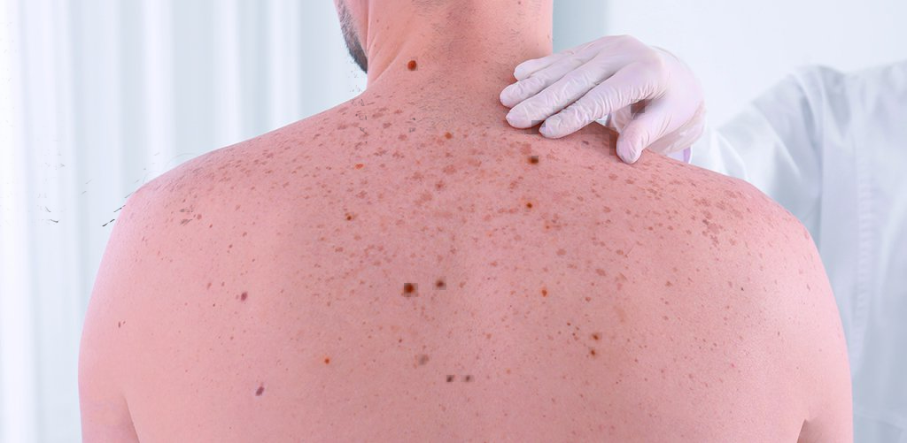 Ne pas attendre l’été pour se protéger du soleil