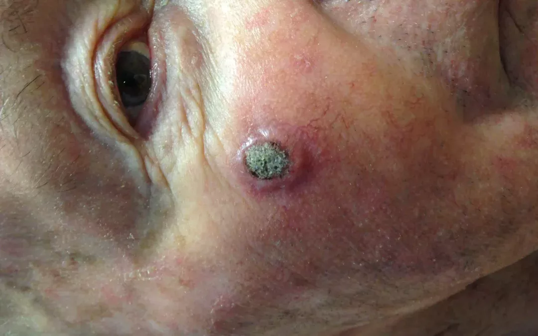 Certains carcinomes épidermoïdes de la peau sont aussi dangereux que le mélanome