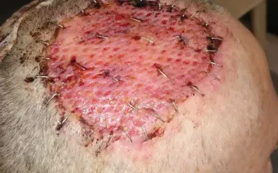 Carcinome épidermoïde : les raisons possibles d’une chirurgie « sous optimale »